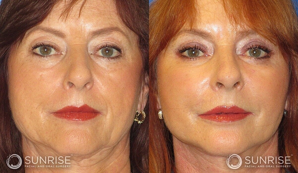 Deep Plane Facelift Before & After