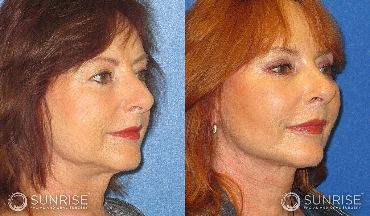 Deep Plane Facelift Before & After