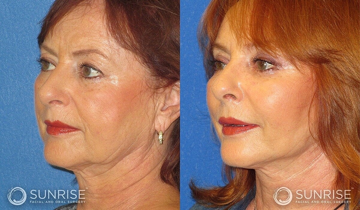 Deep Plane Facelift Before & After