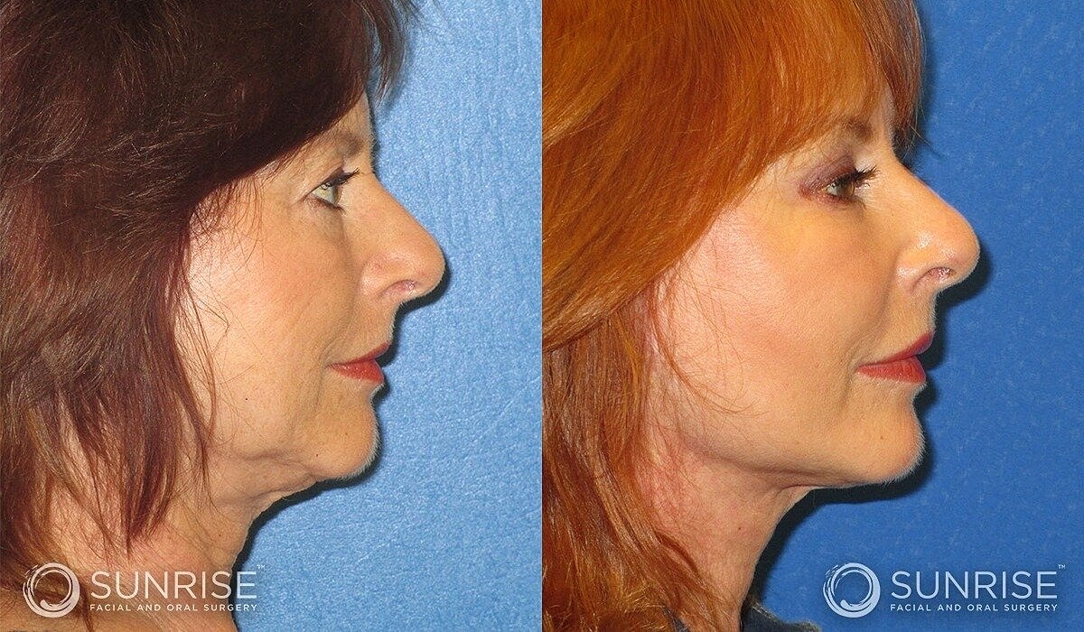 Deep Plane Facelift Before & After