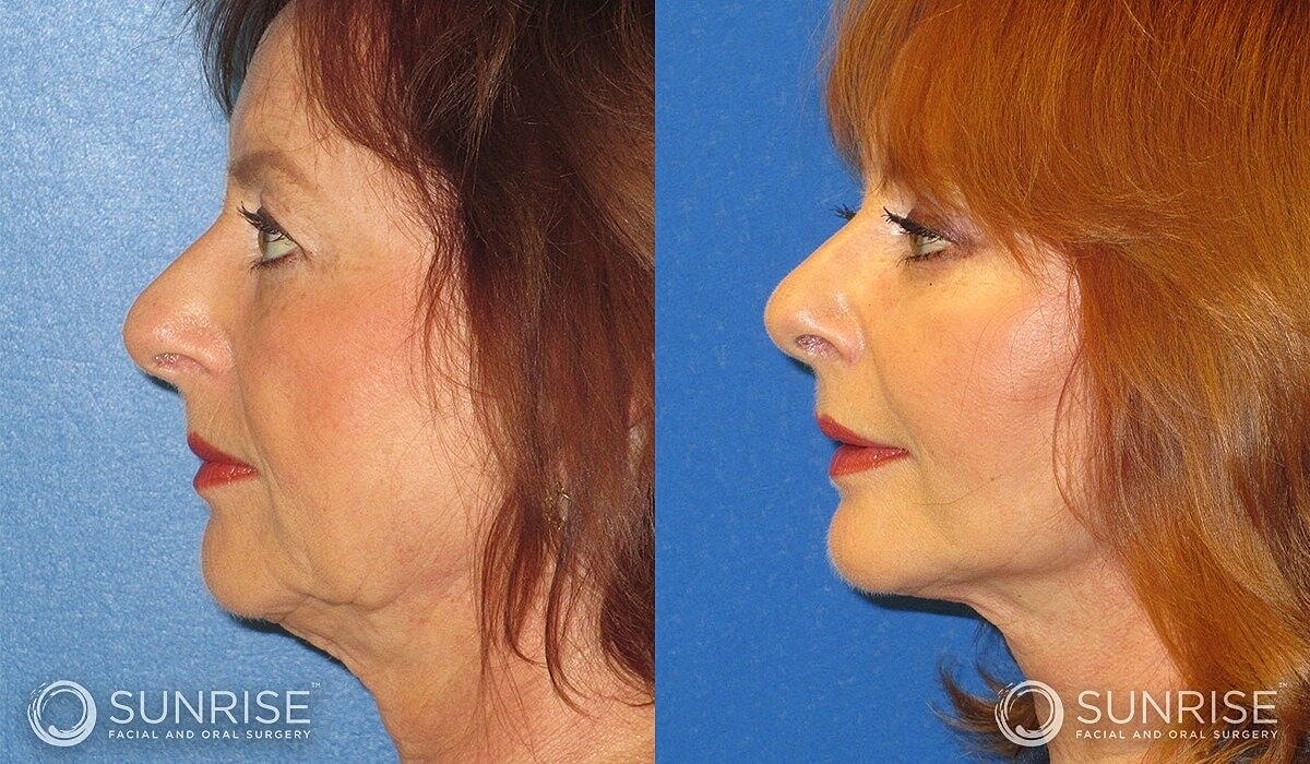 Deep Plane Facelift Before & After