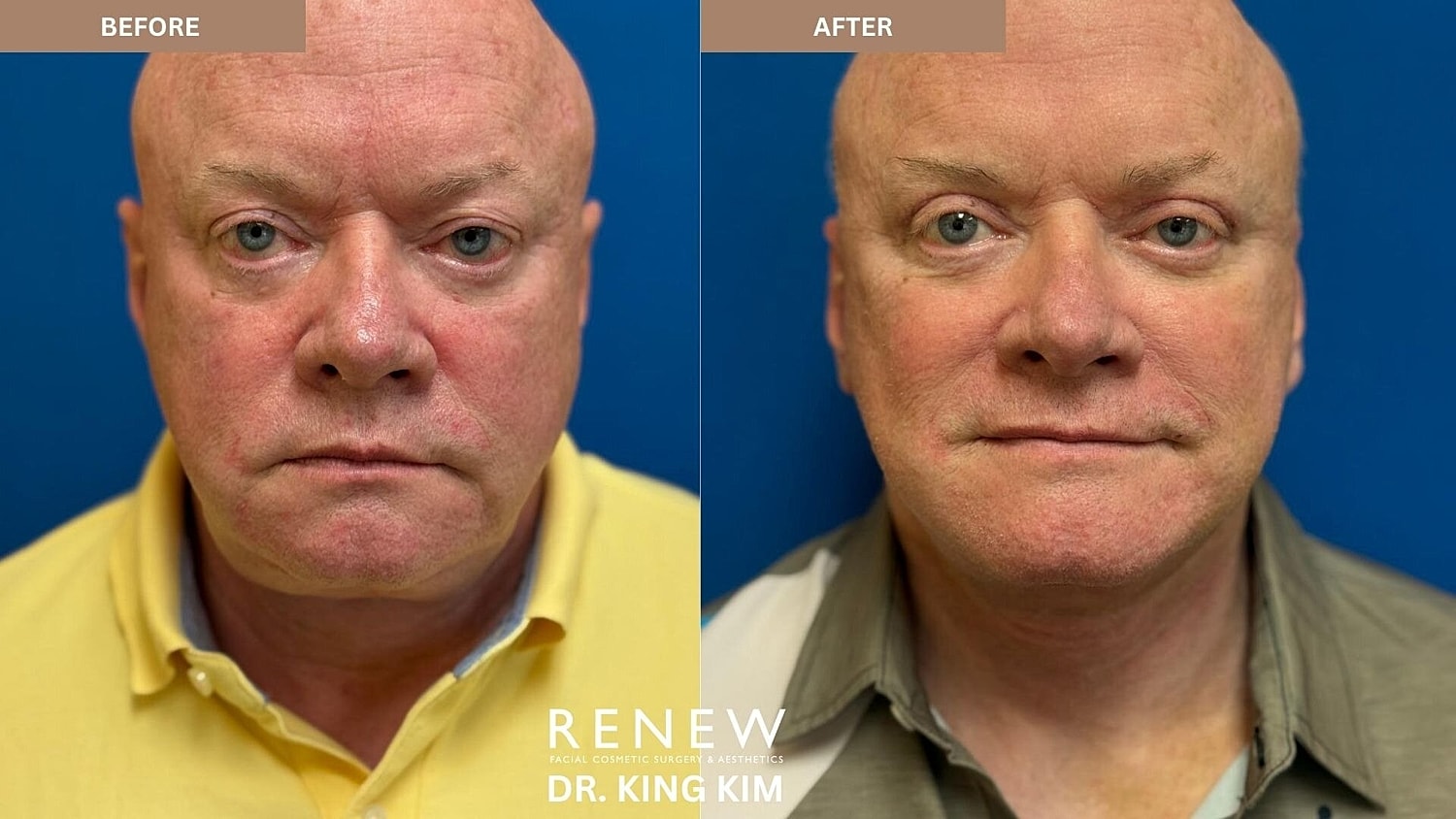 Deep Plane Facelift Before & After
