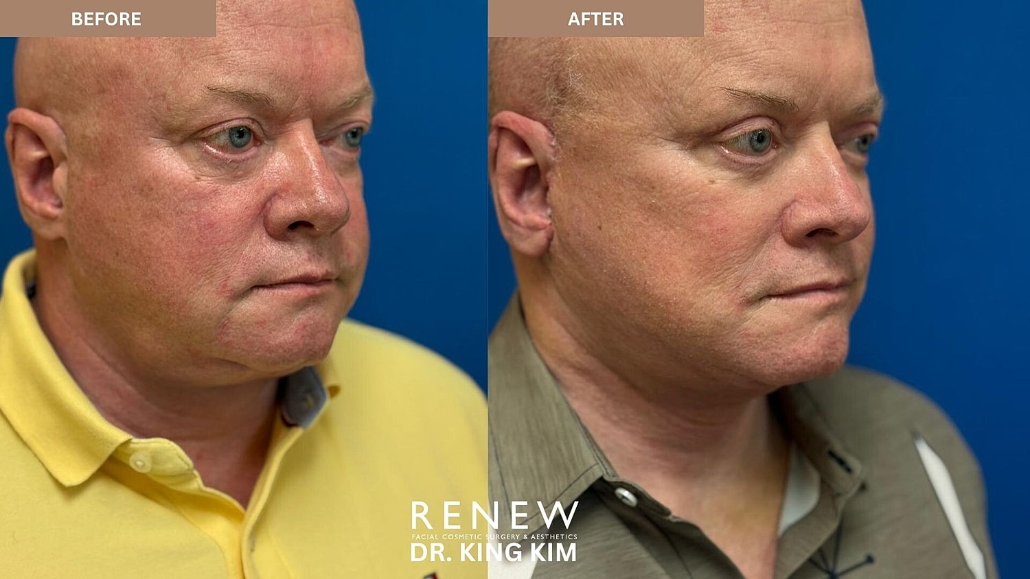 Deep Plane Facelift Before & After