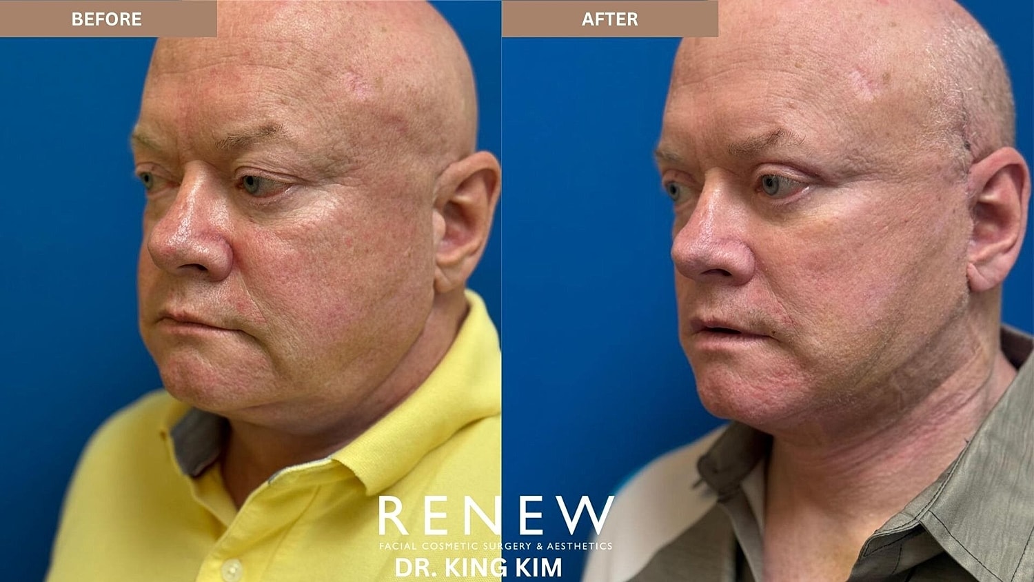 Deep Plane Facelift Before & After