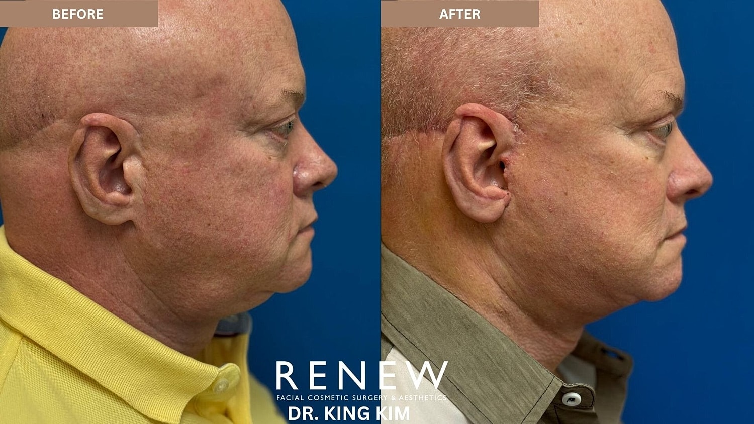 Deep Plane Facelift Before & After