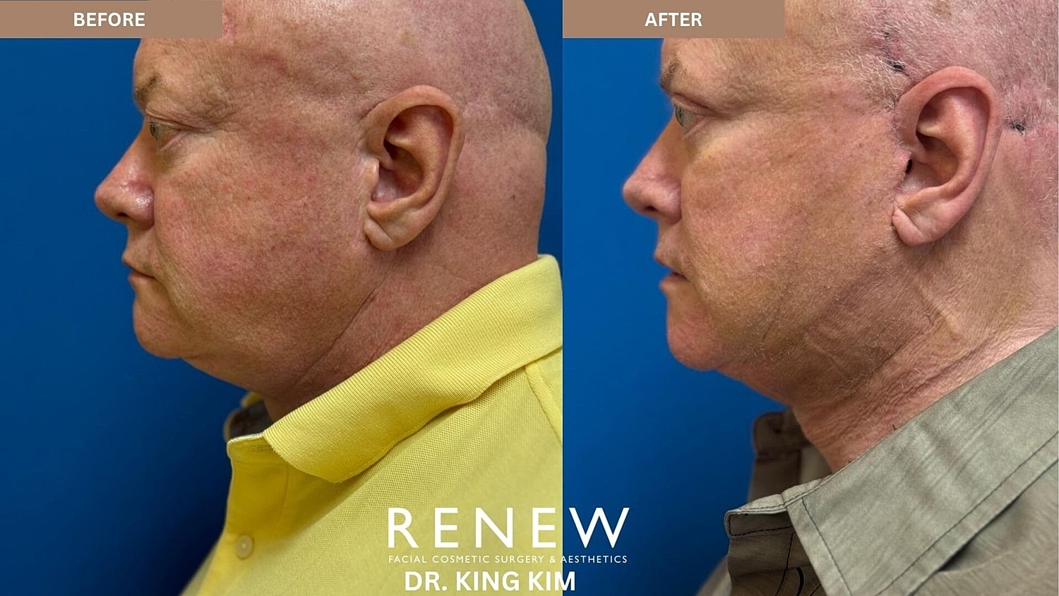 Deep Plane Facelift Before & After