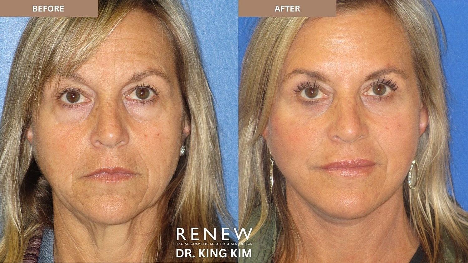 Deep Plane Facelift Before & After