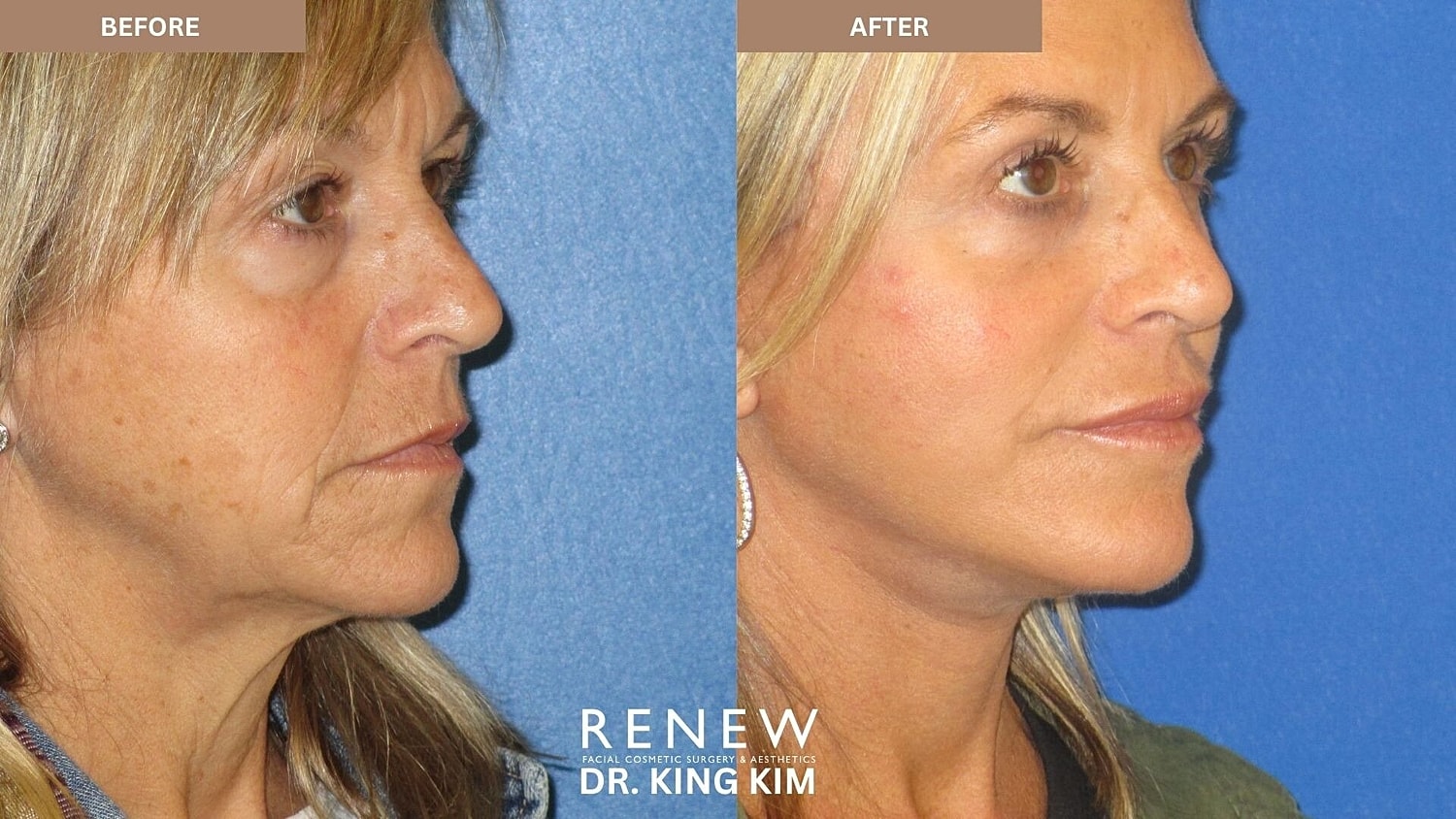Deep Plane Facelift Before & After