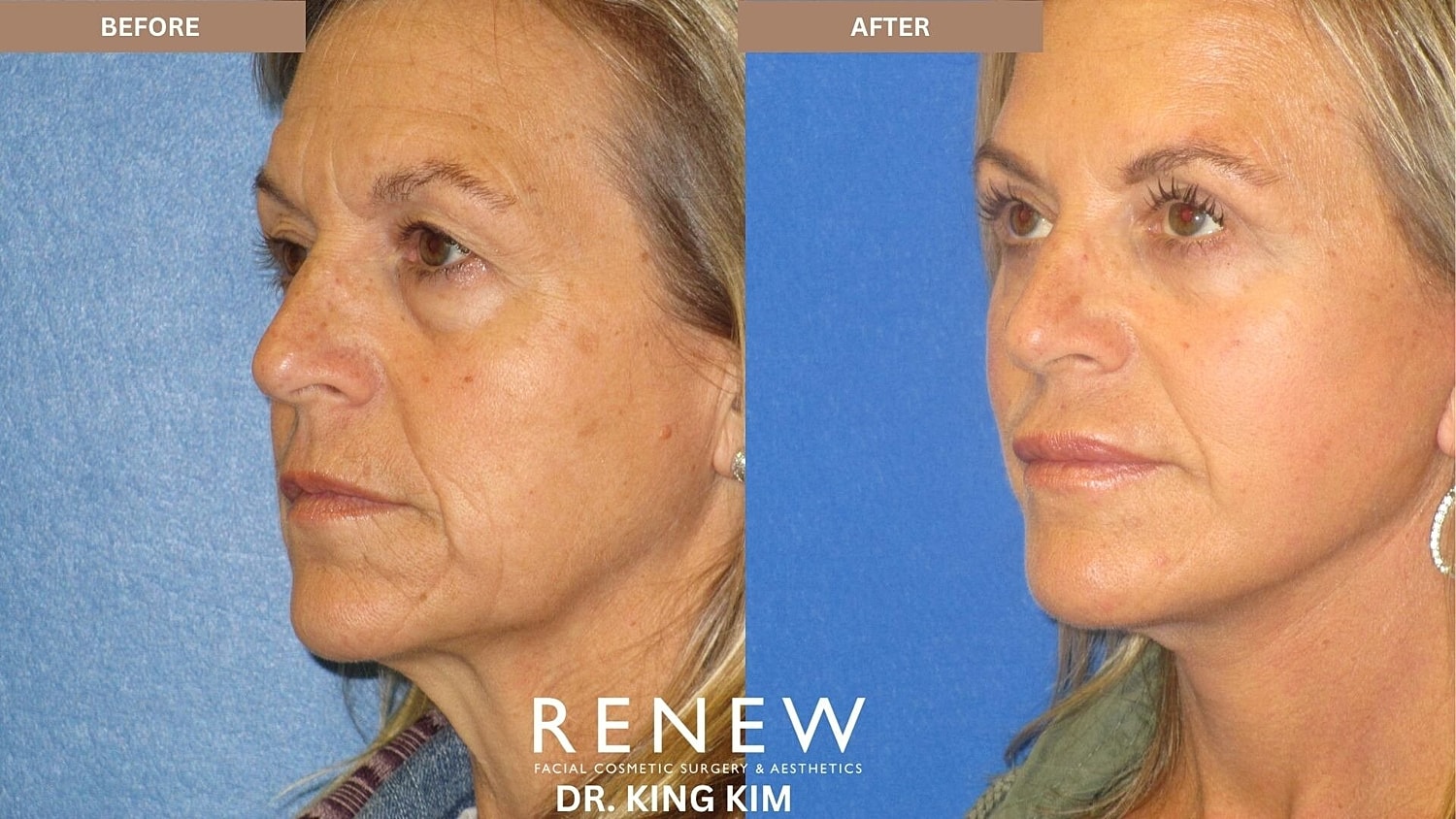 Deep Plane Facelift Before & After