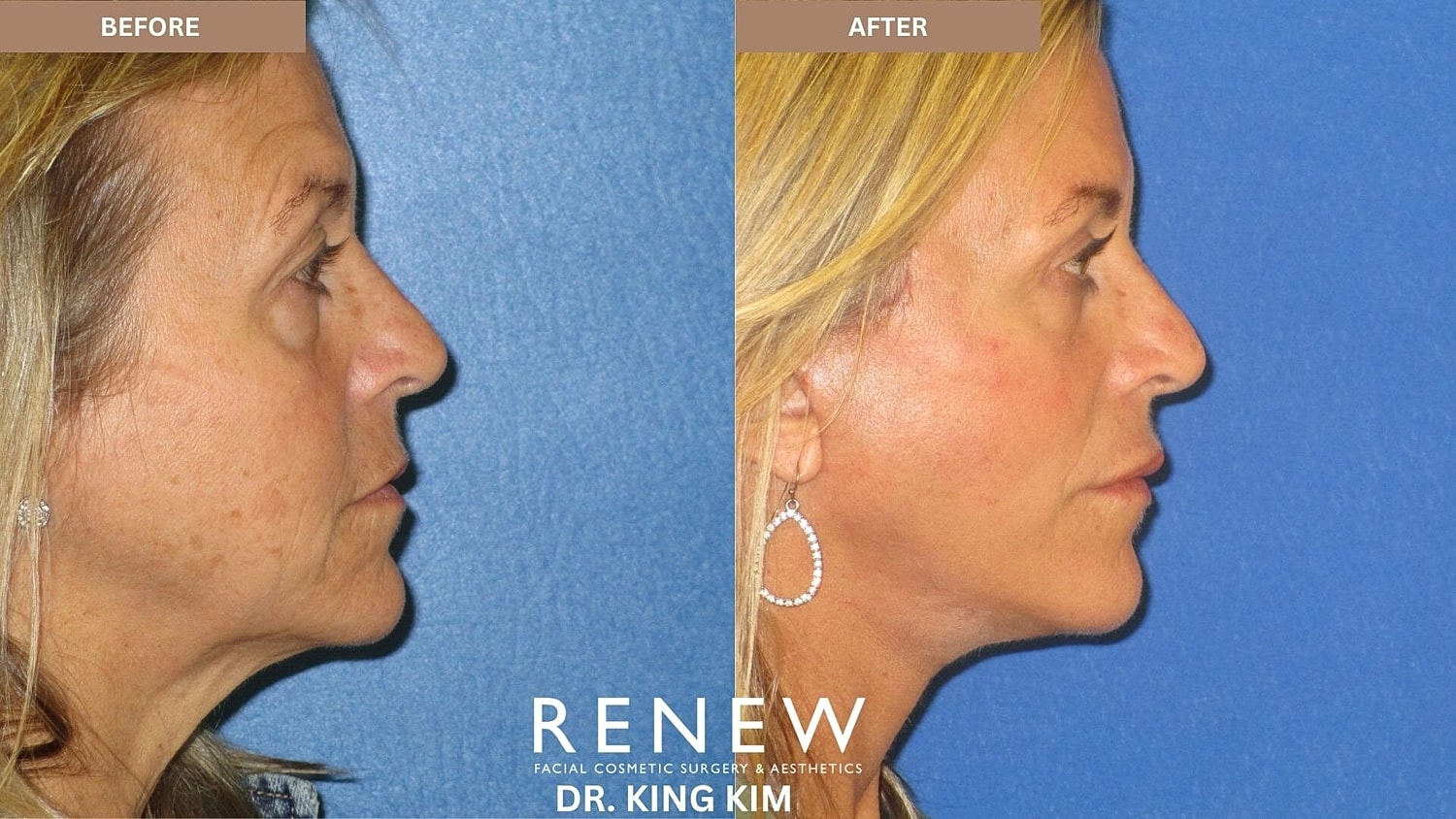 Deep Plane Facelift Before & After