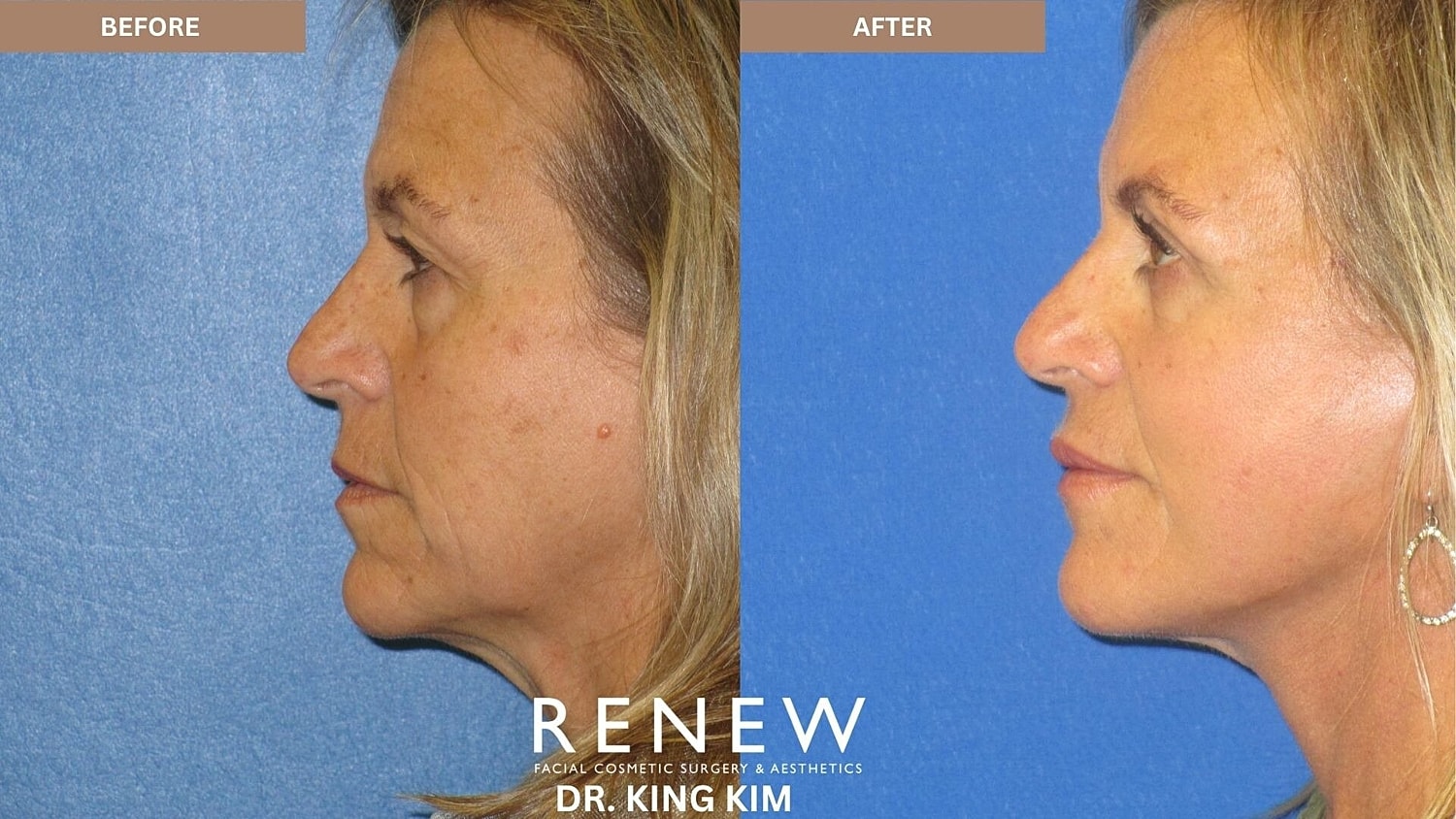 Deep Plane Facelift Before & After