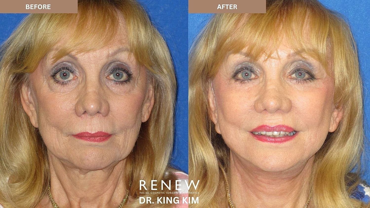 Deep Plane Facelift Before & After