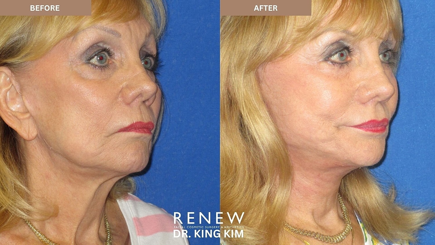 Deep Plane Facelift Before & After