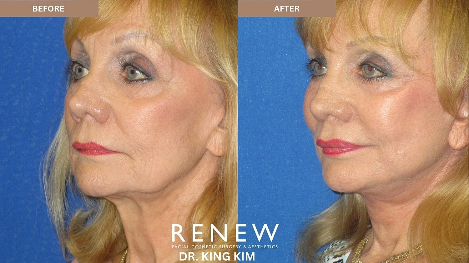 Deep Plane Facelift Before & After