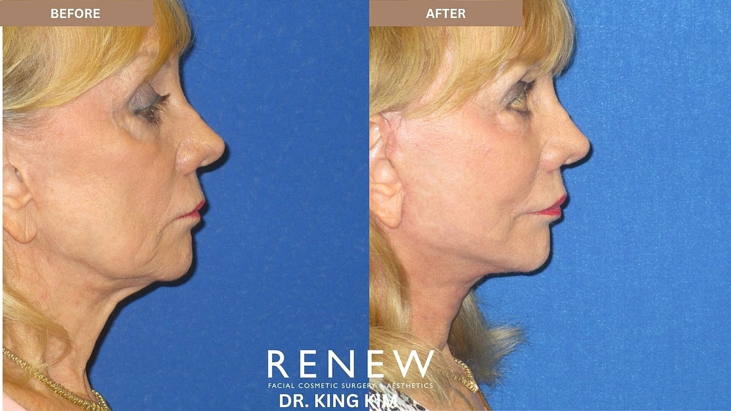 Deep Plane Facelift Before & After