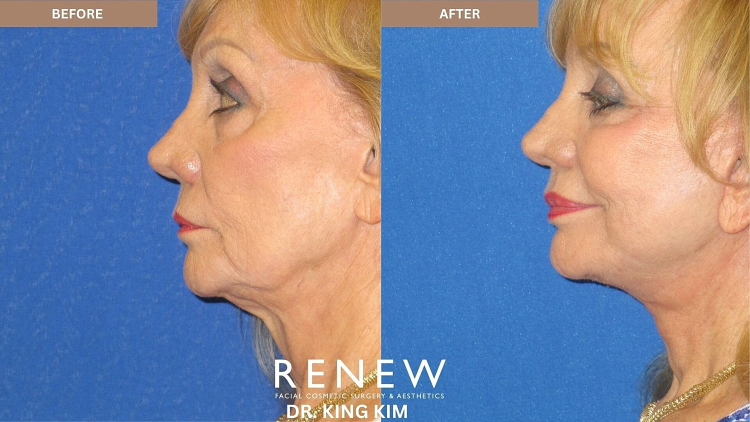 Deep Plane Facelift Before & After