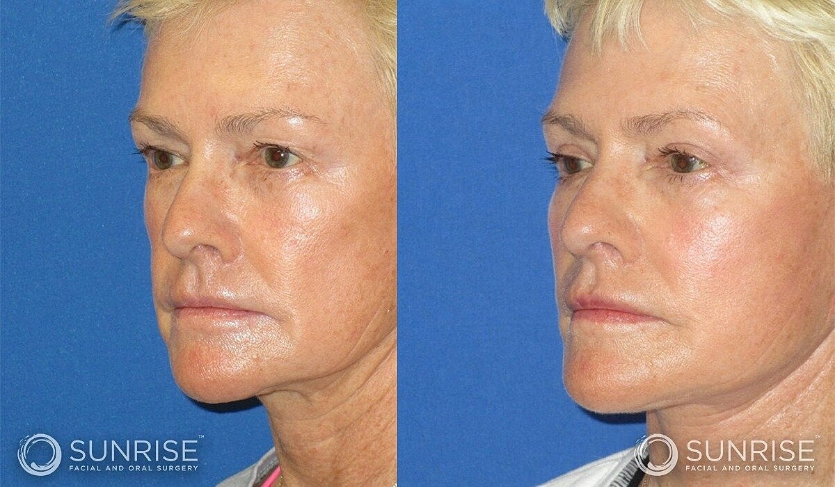 Deep Plane Facelift Before & After