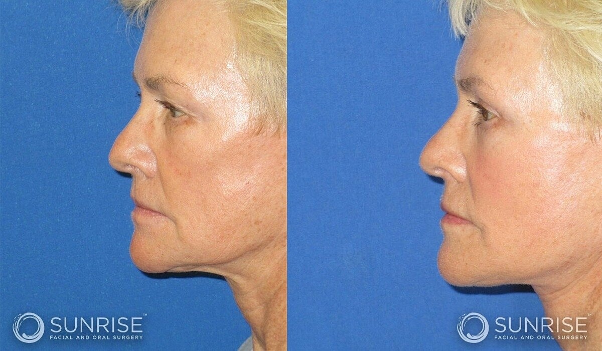 Deep Plane Facelift Before & After