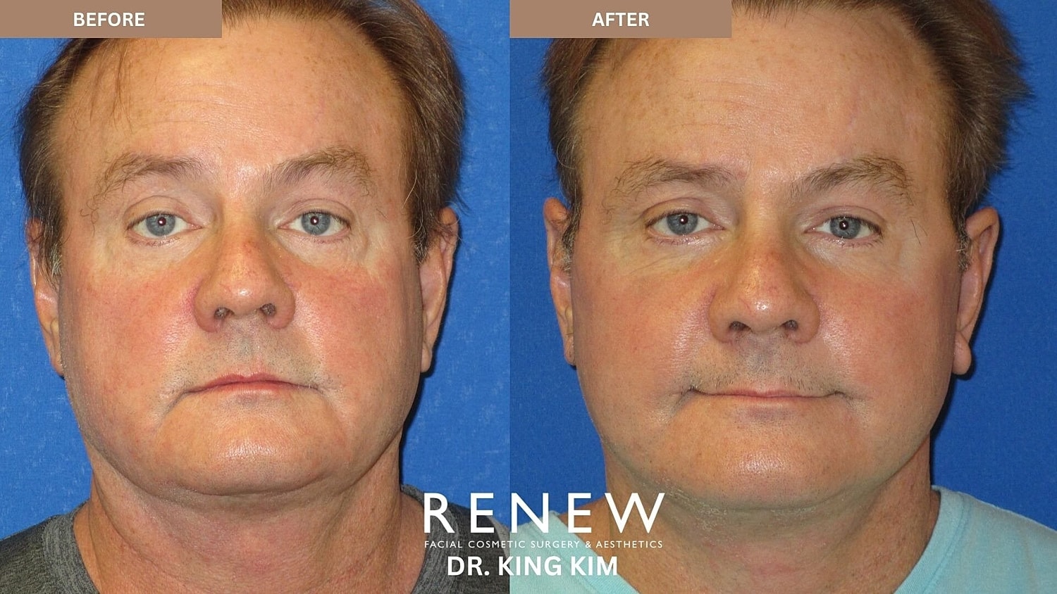 Deep Plane Facelift Before & After
