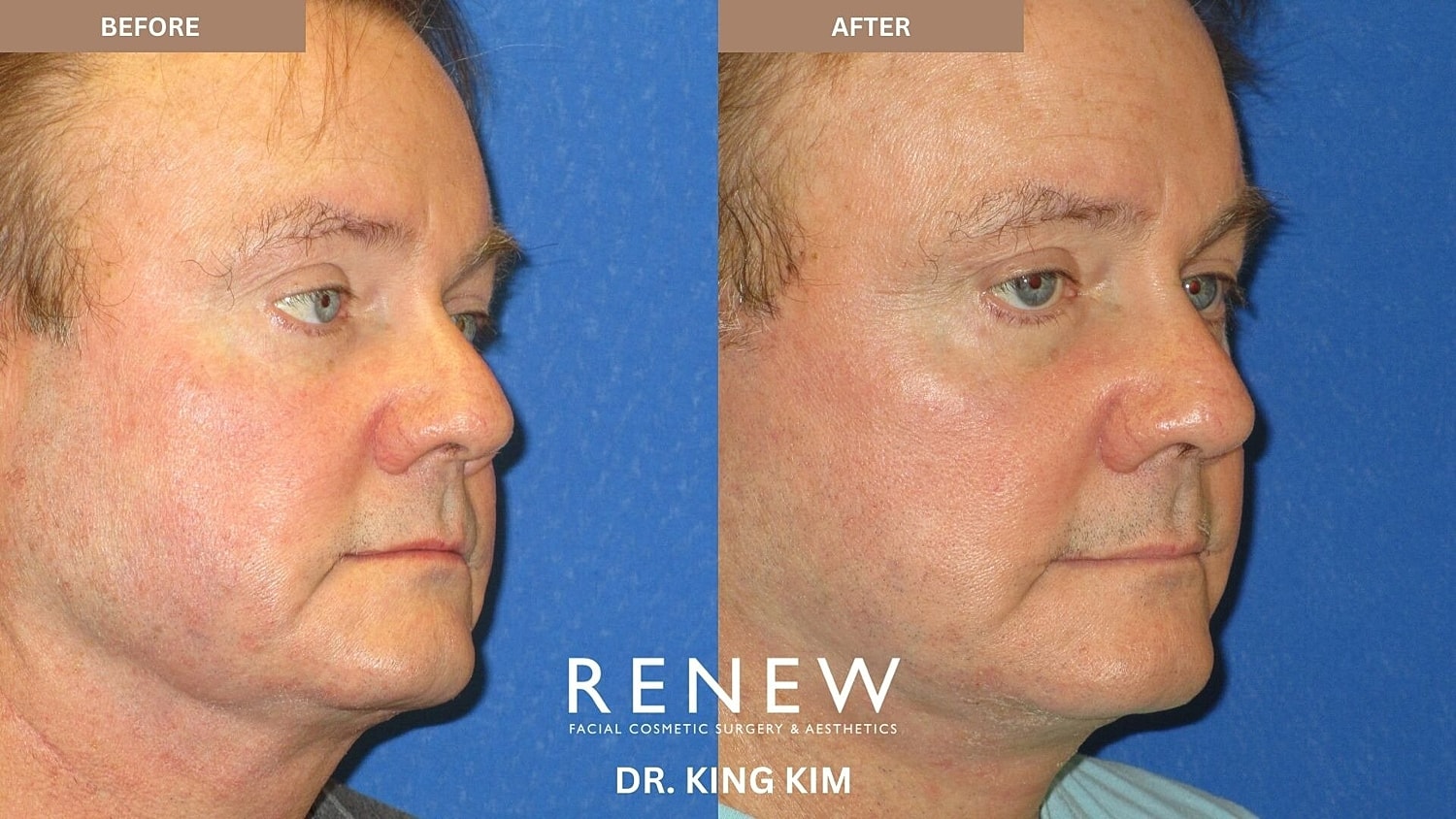 Deep Plane Facelift Before & After