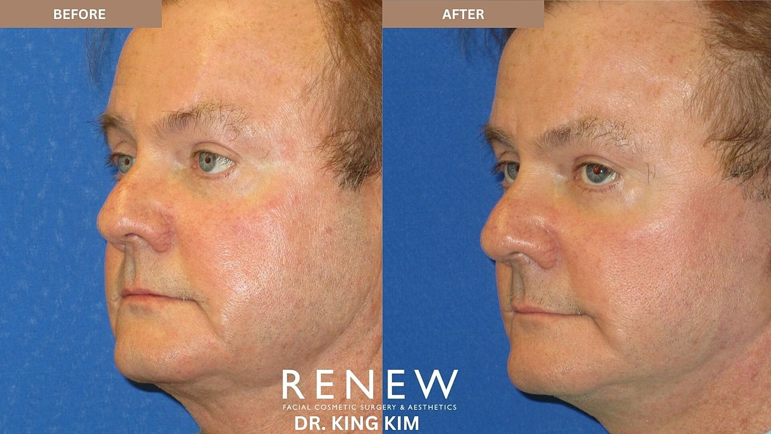 Deep Plane Facelift Before & After