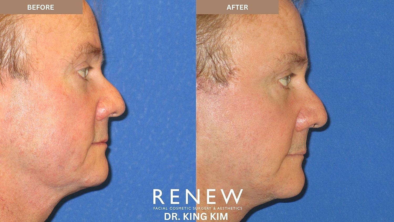 Deep Plane Facelift Before & After