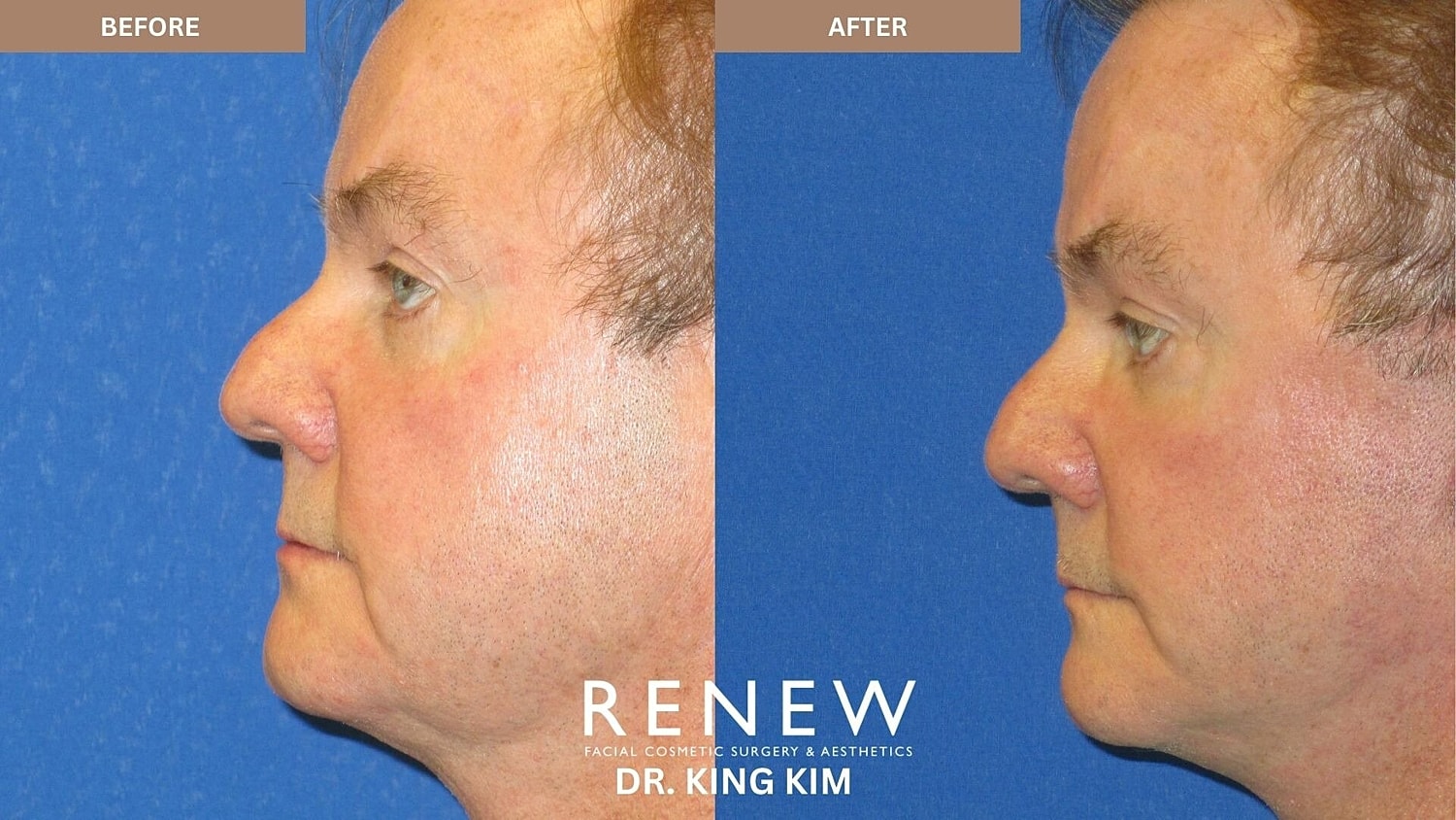 Deep Plane Facelift Before & After