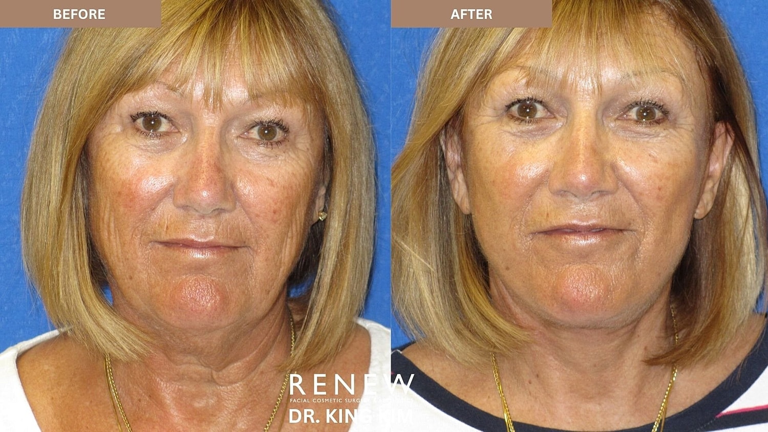 Deep Plane Facelift Before & After
