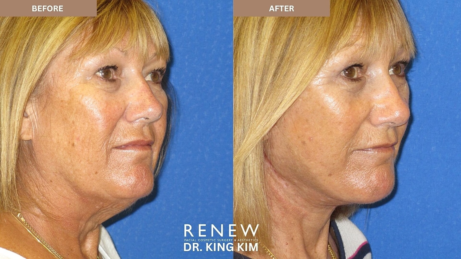 Deep Plane Facelift Before & After