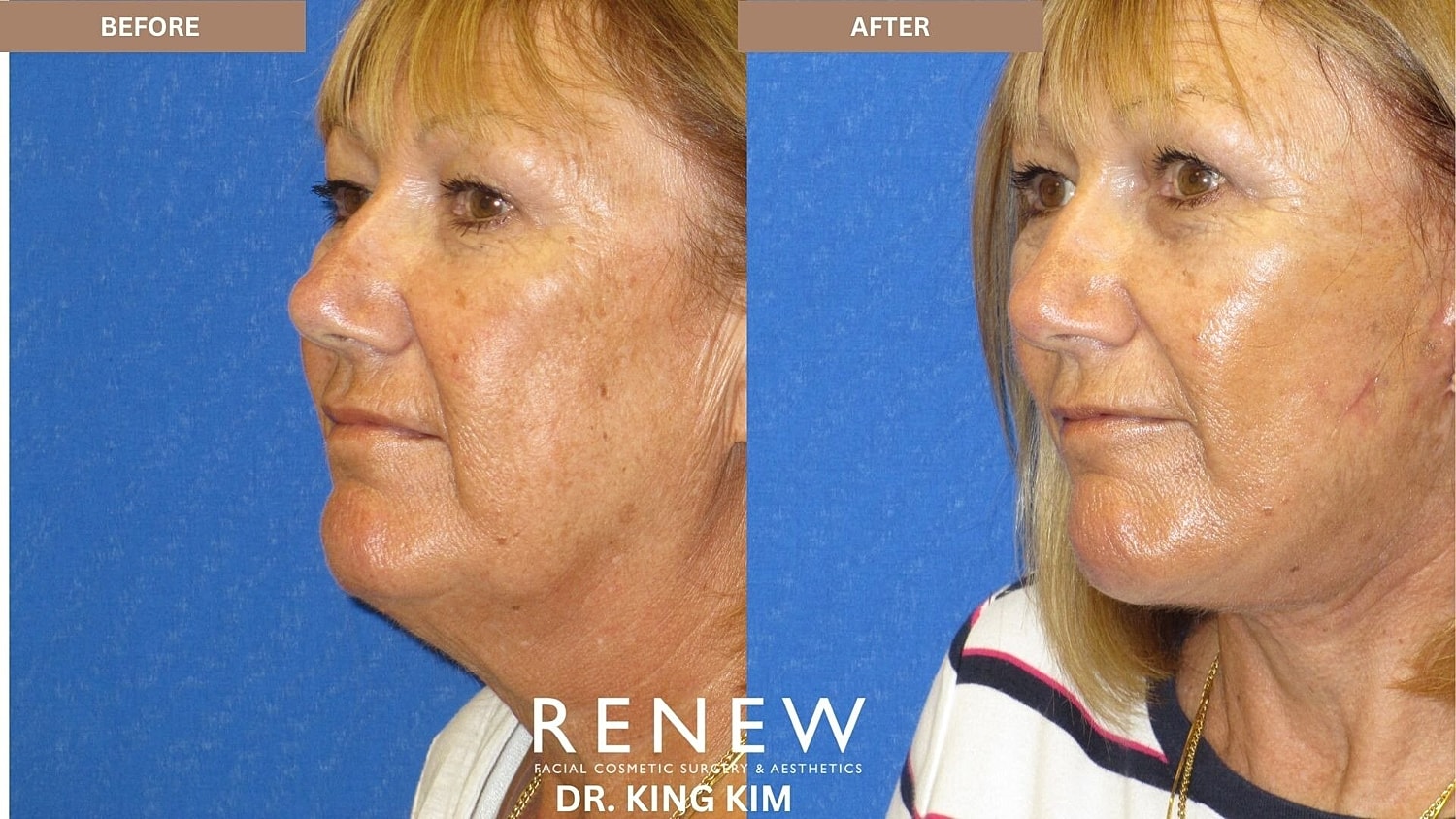 Deep Plane Facelift Before & After