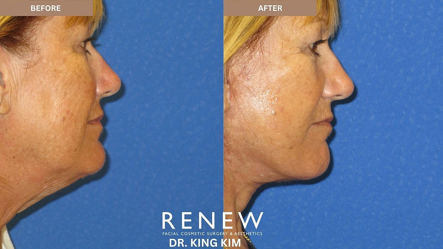 Deep Plane Facelift Before & After