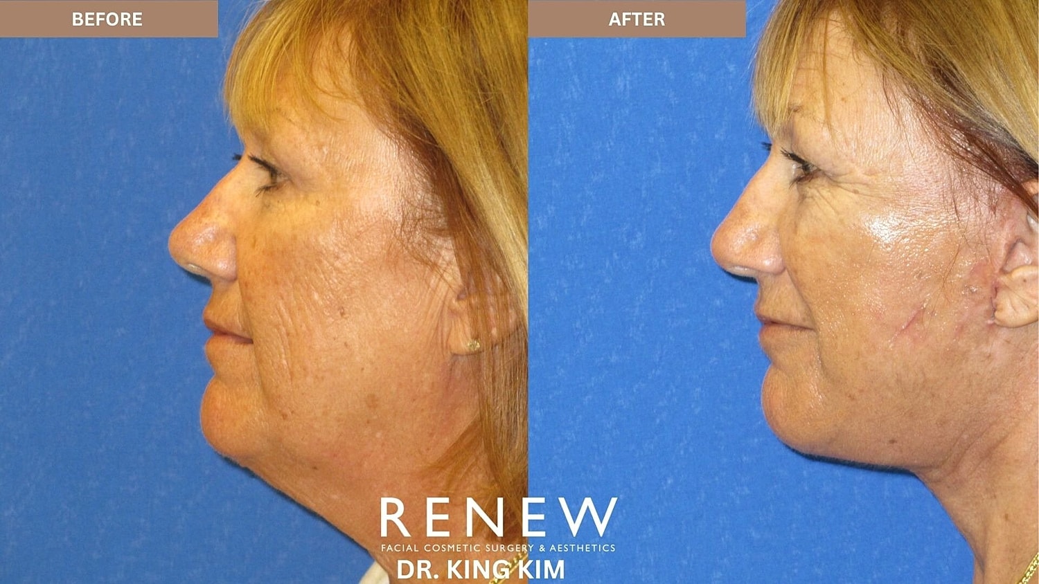 Deep Plane Facelift Before & After