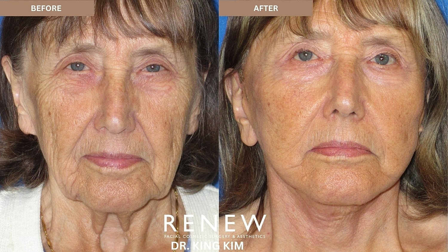 Deep Plane Facelift Before & After