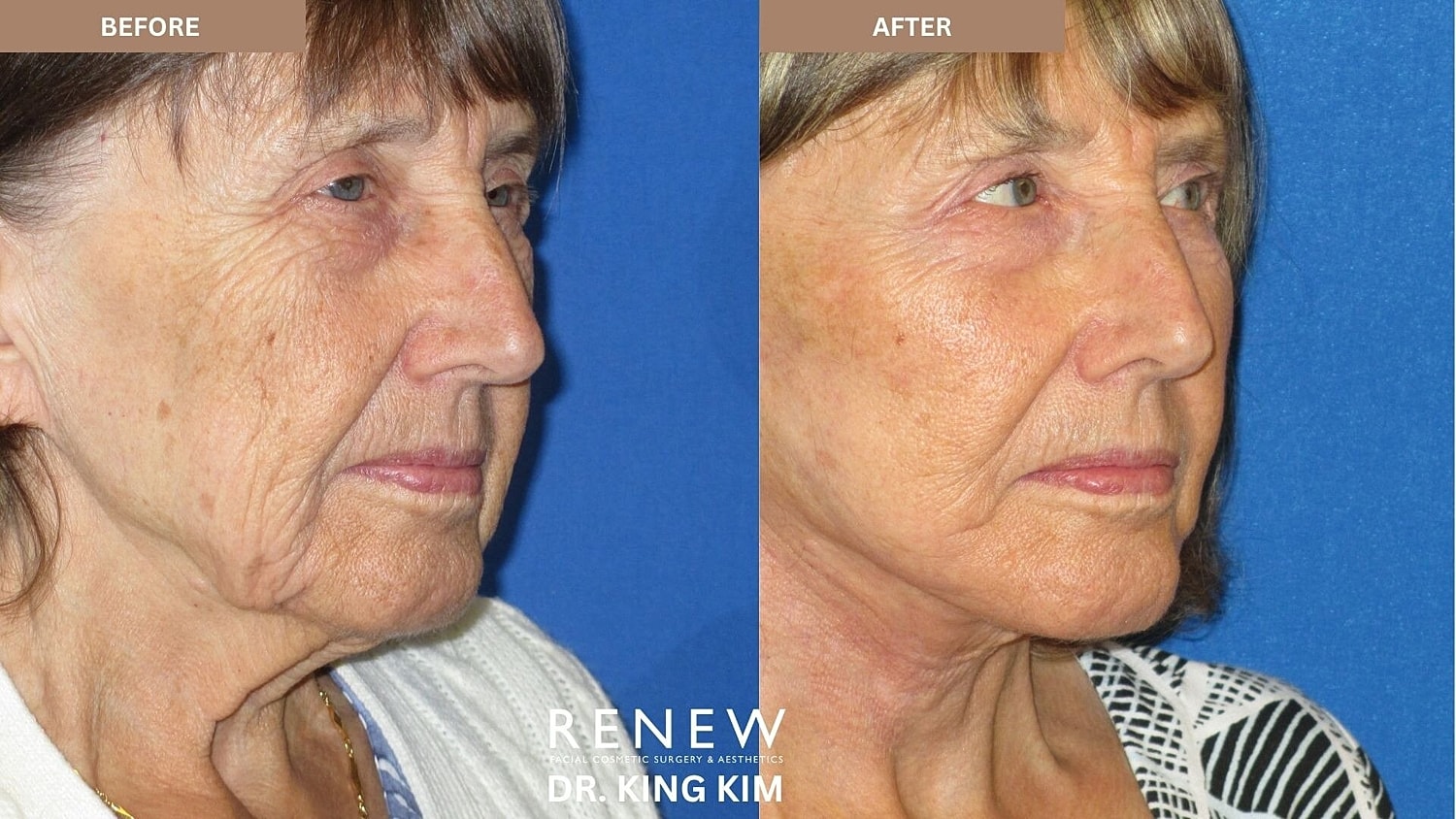 Deep Plane Facelift Before & After