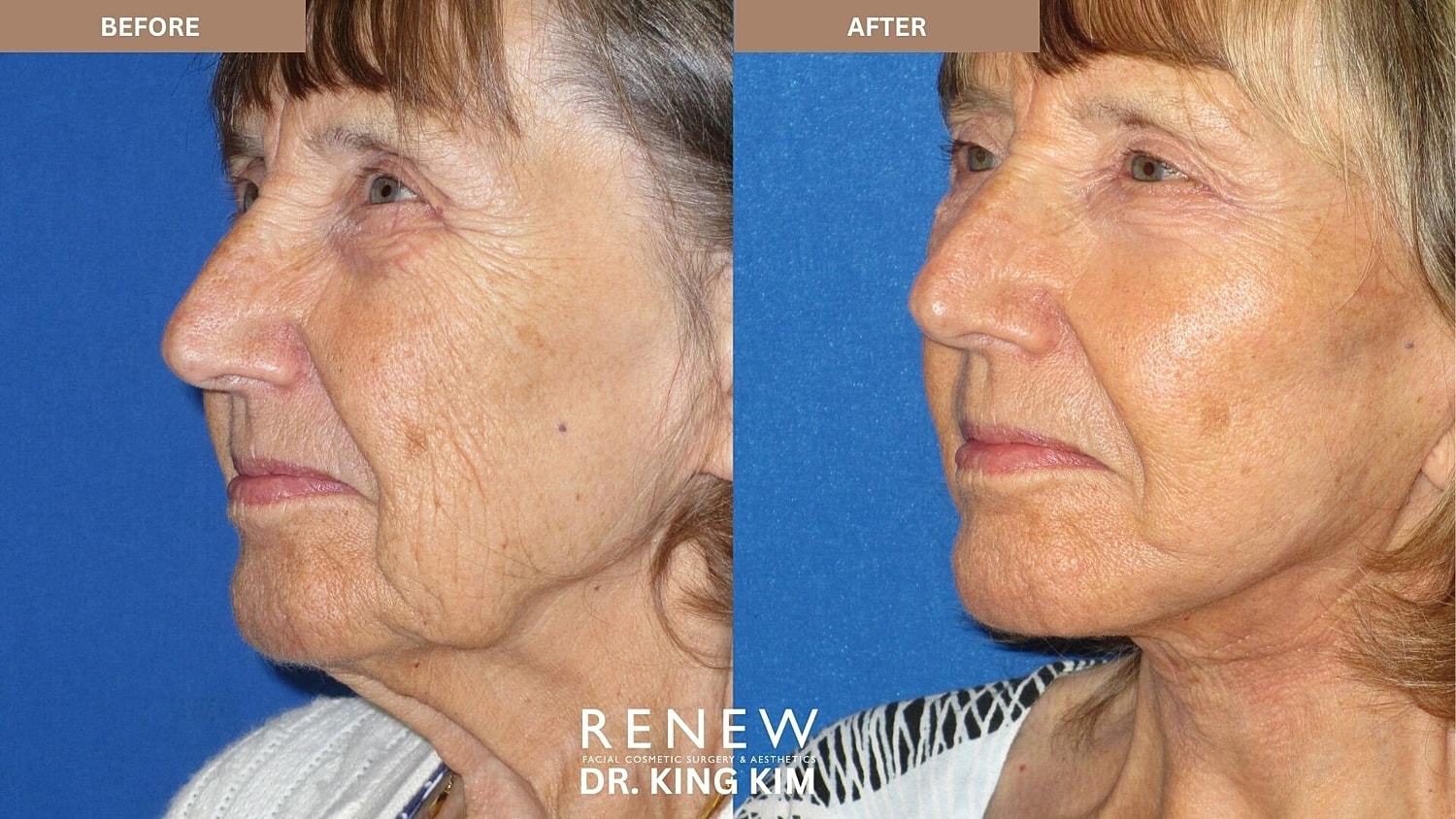 Deep Plane Facelift Before & After