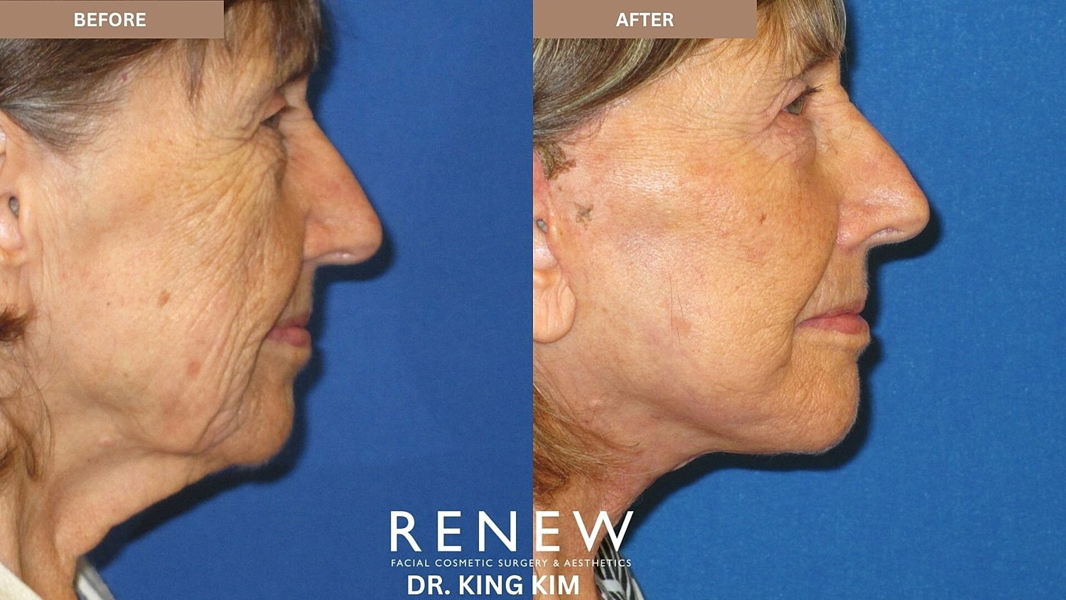 Deep Plane Facelift Before & After