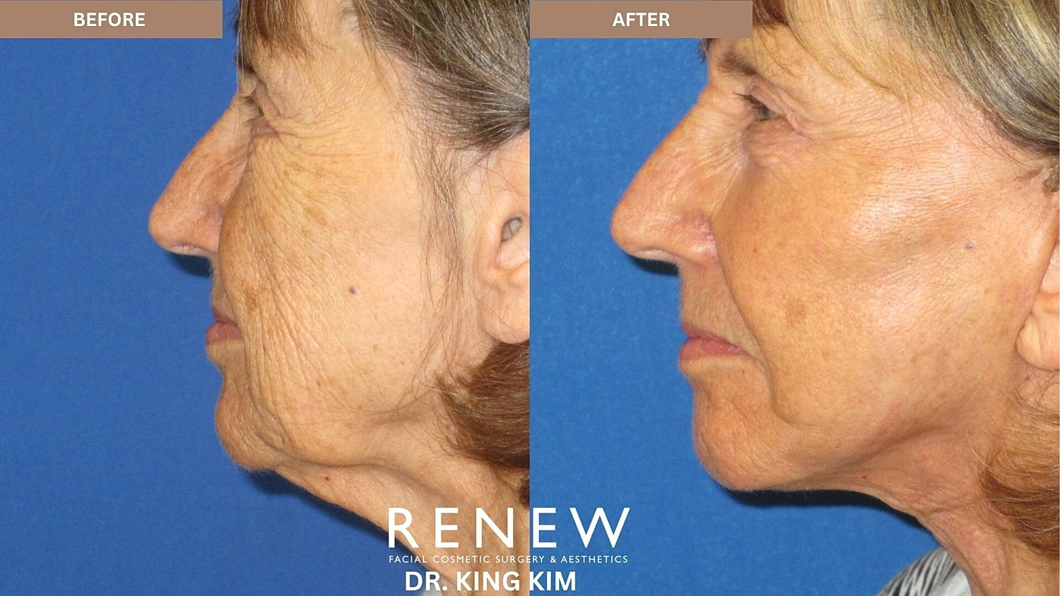 Deep Plane Facelift Before & After