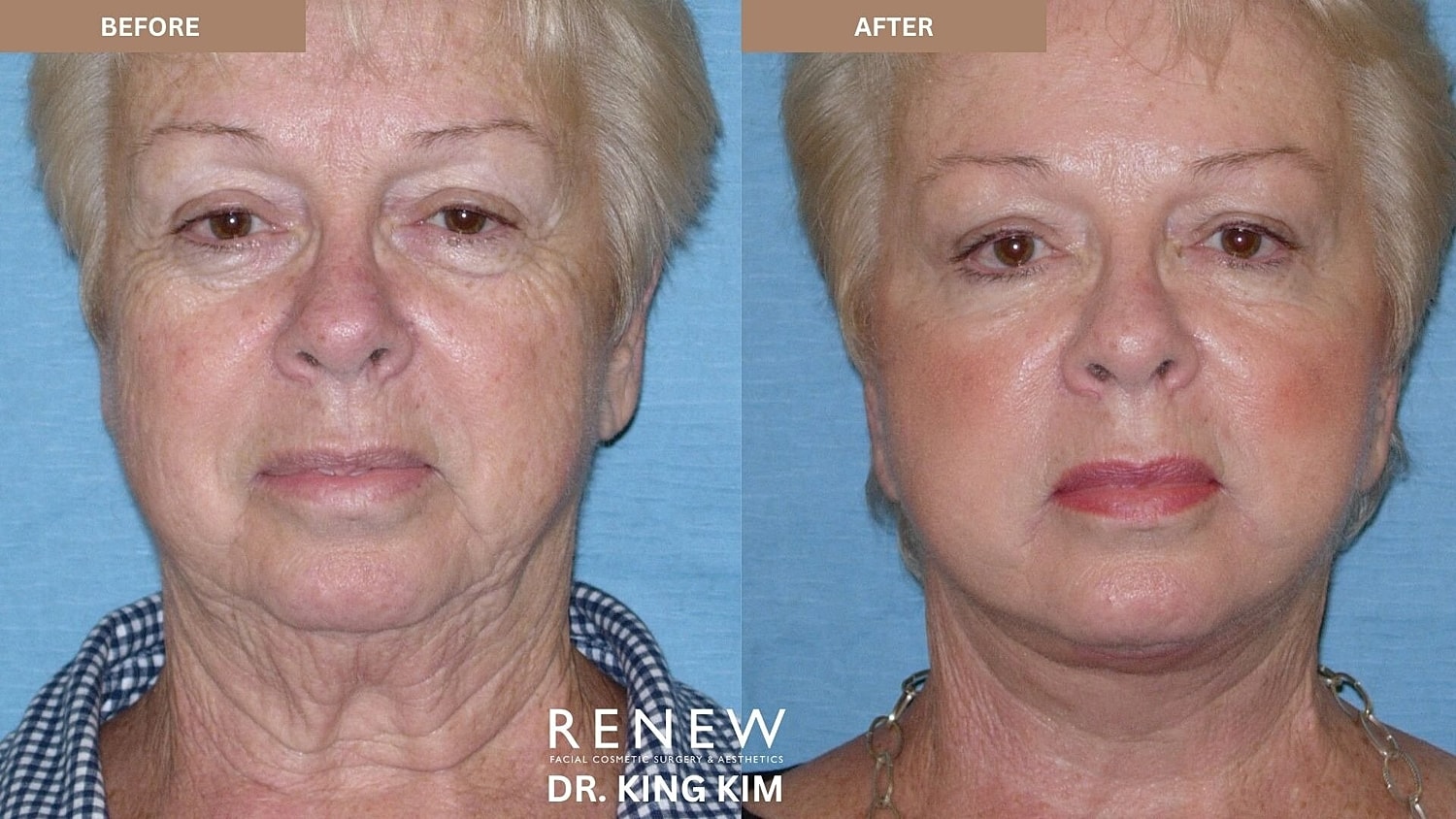 Deep Plane Facelift Before & After