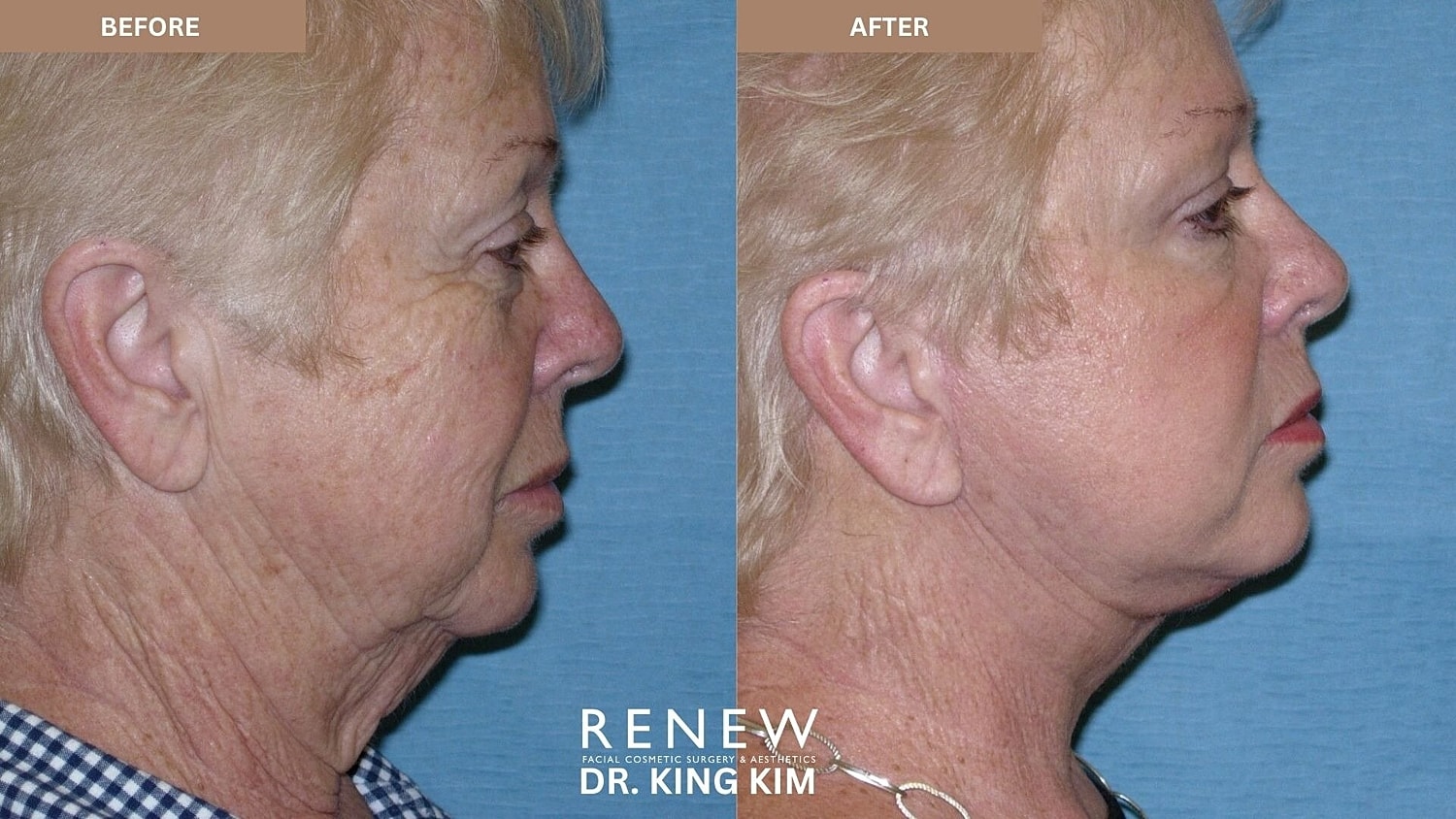 Deep Plane Facelift Before & After