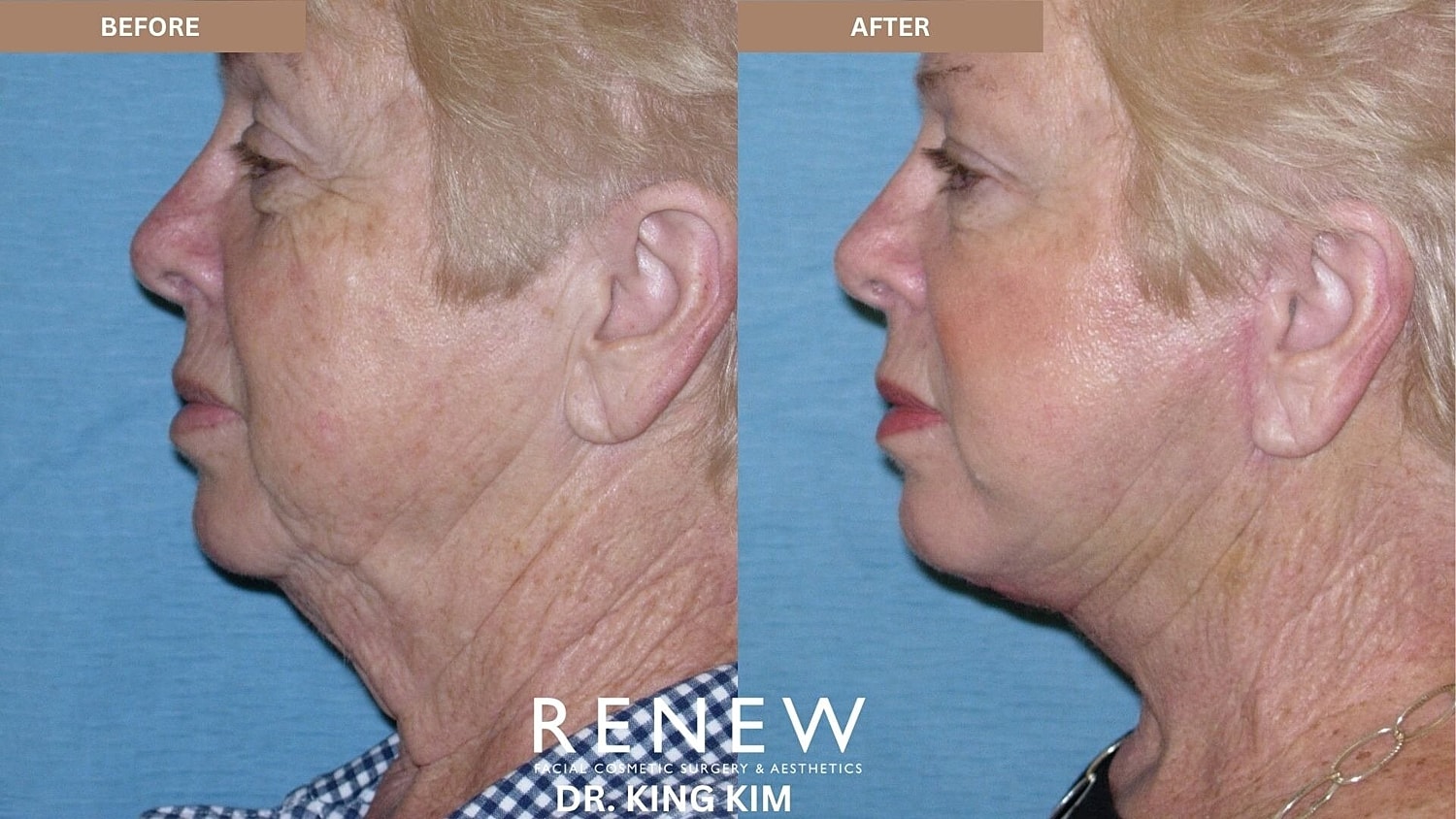 Deep Plane Facelift Before & After