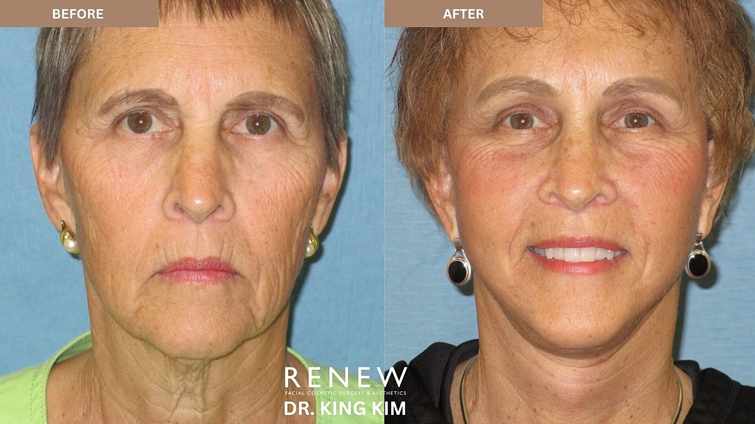 Deep Plane Facelift Before & After