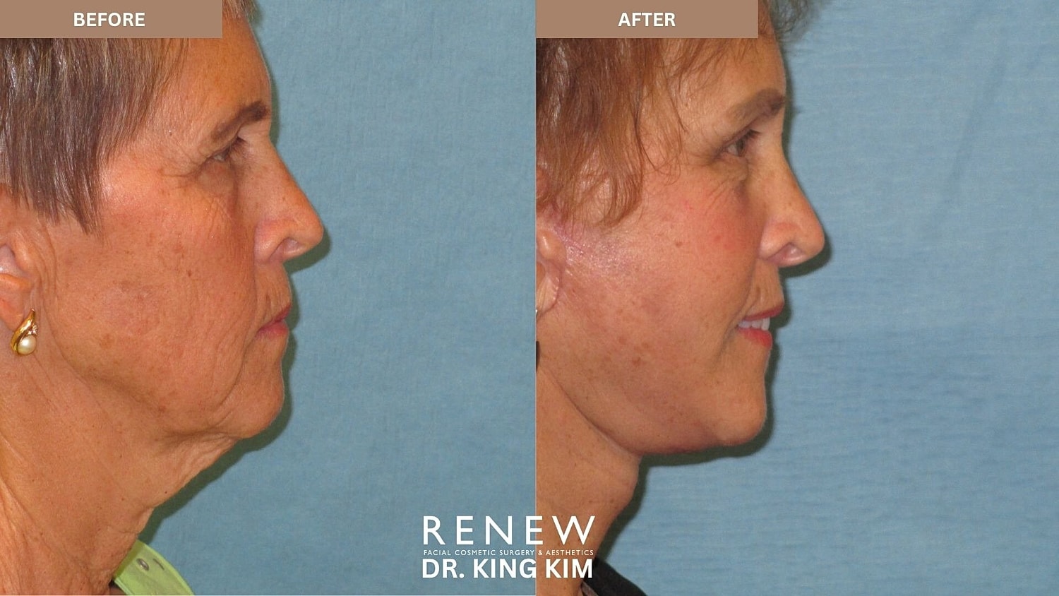 Deep Plane Facelift Before & After