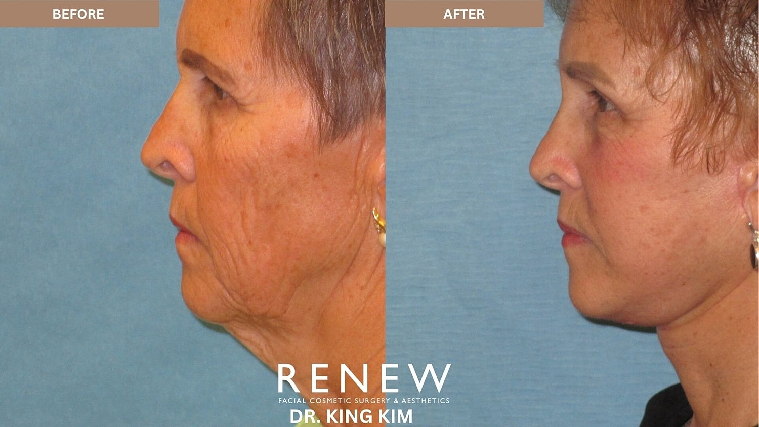 Deep Plane Facelift Before & After