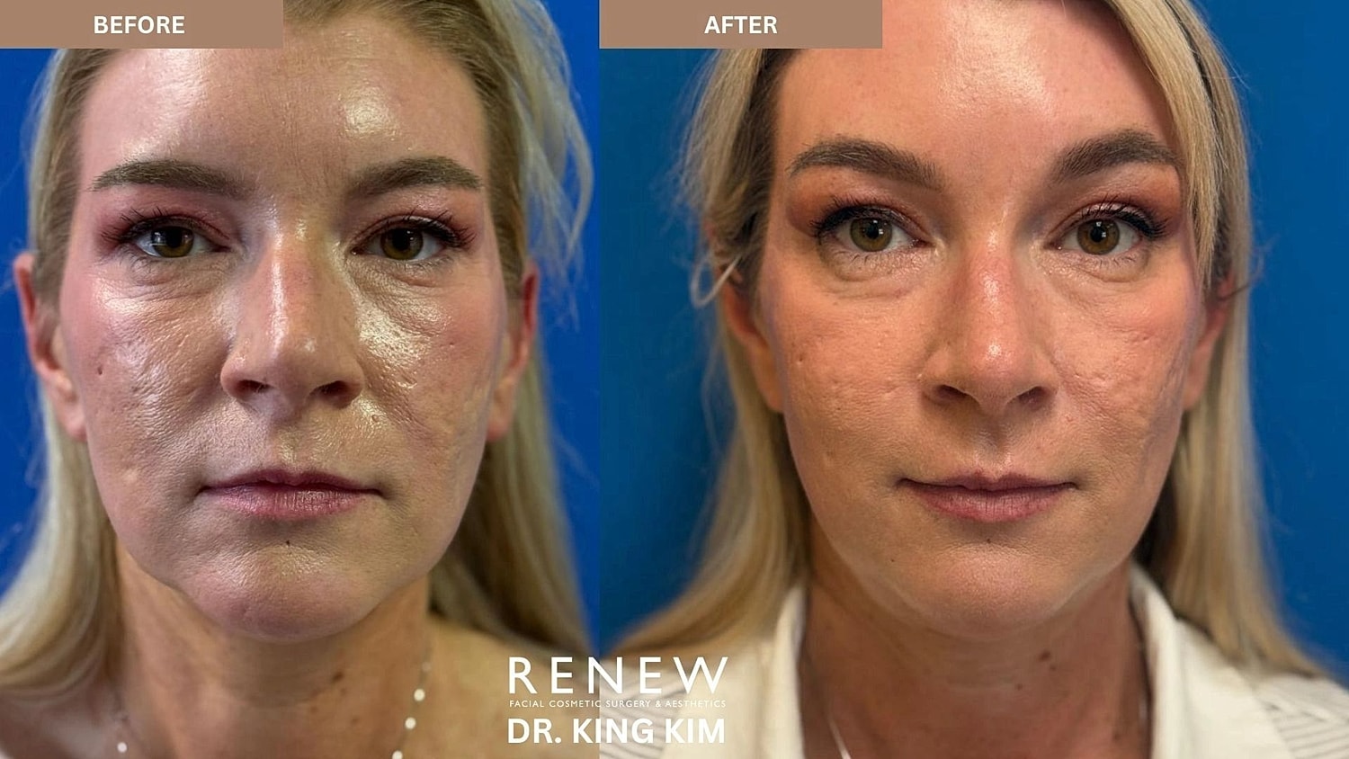 Brow Lift Before & After