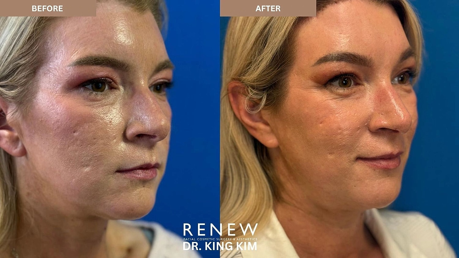 Brow Lift Before & After
