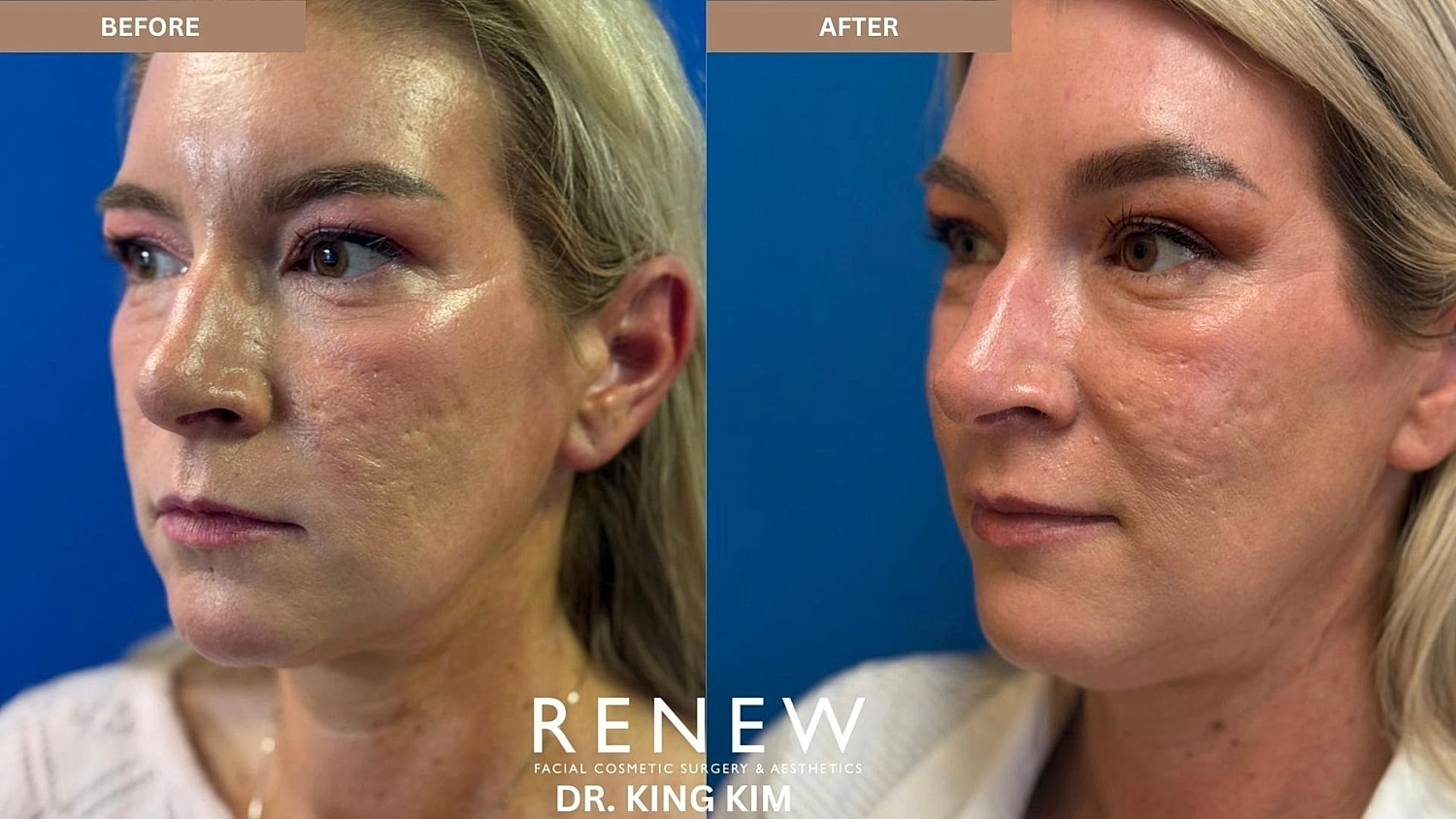 Brow Lift Before & After