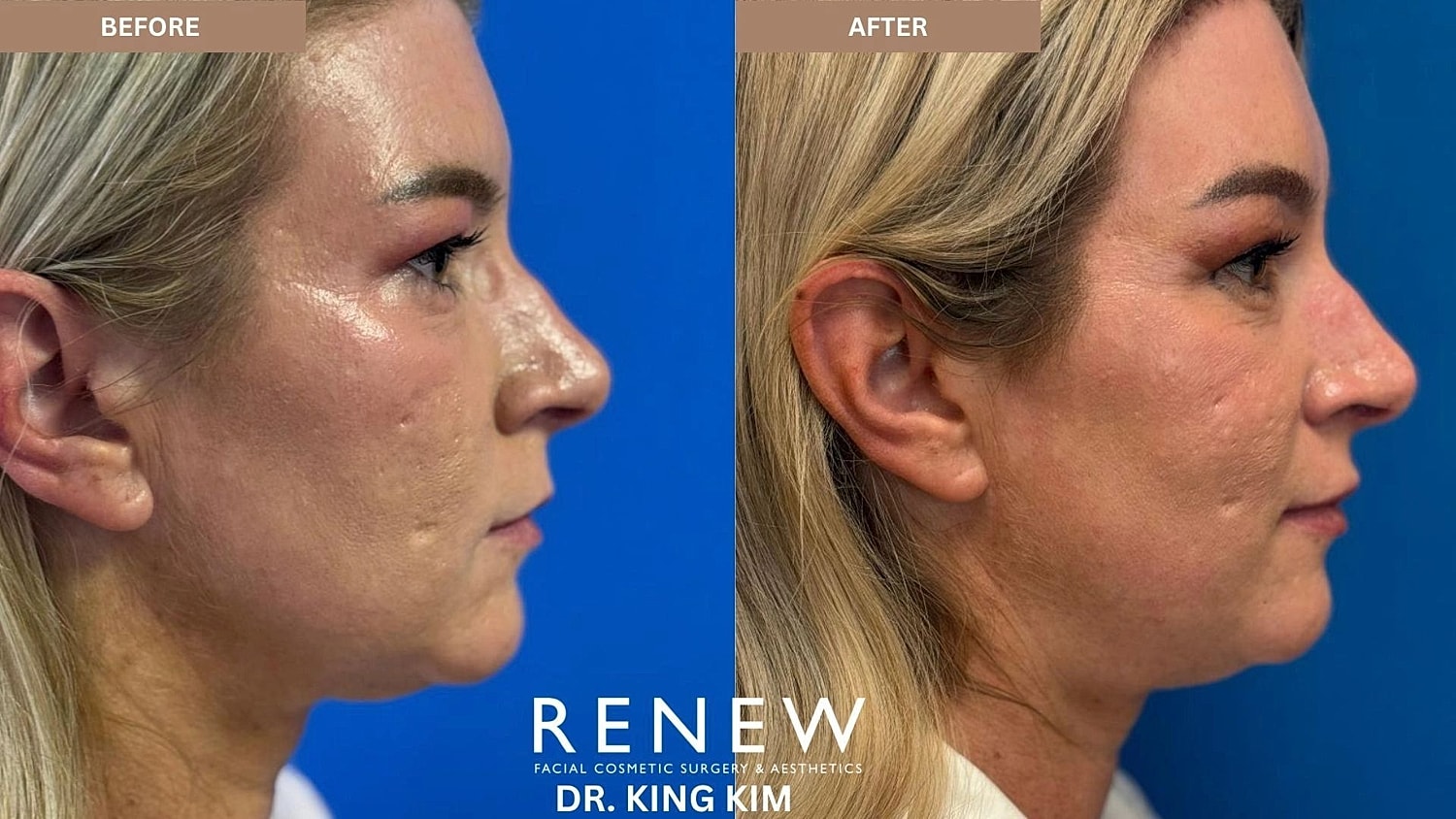 Brow Lift Before & After