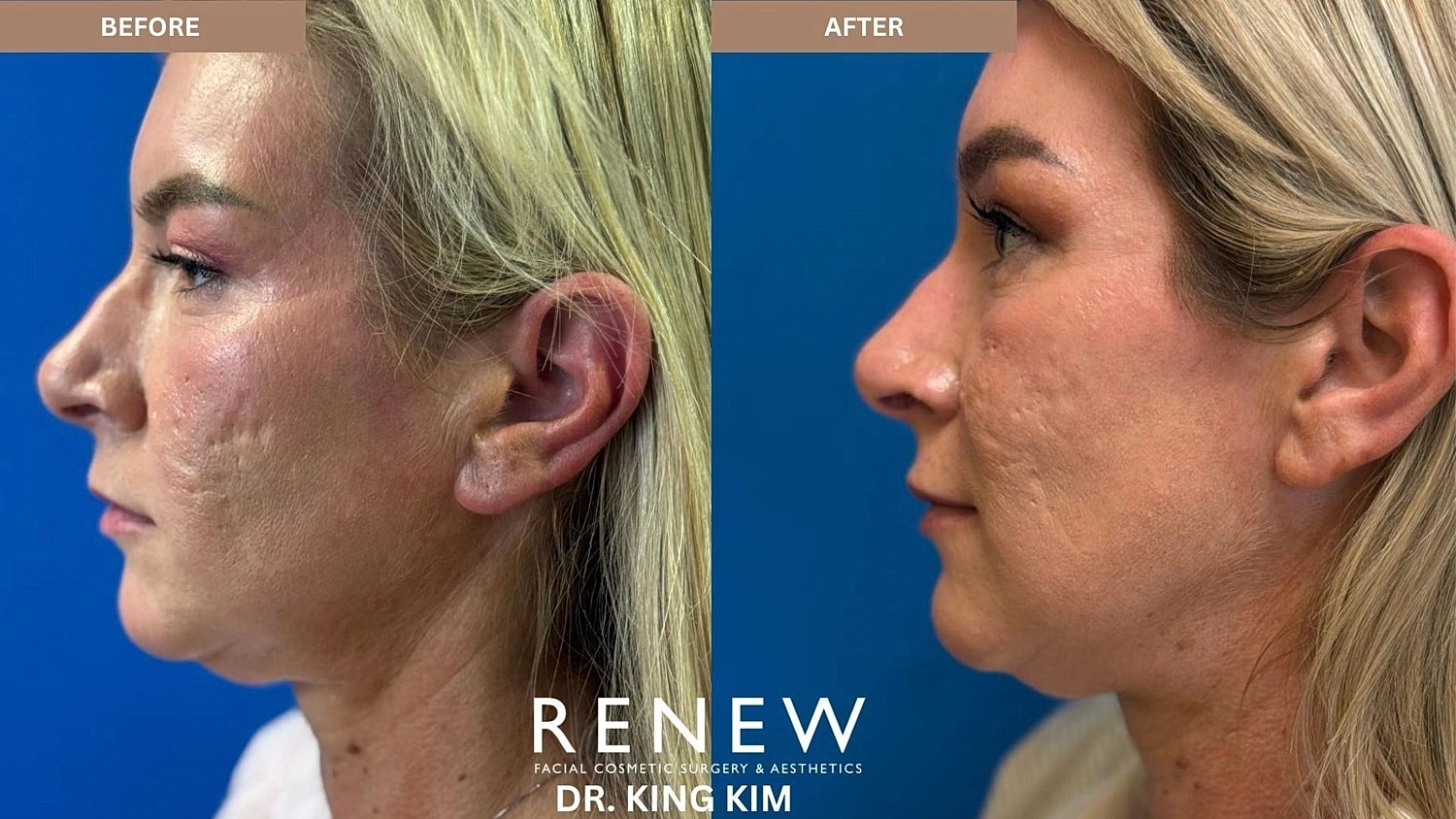 Brow Lift Before & After