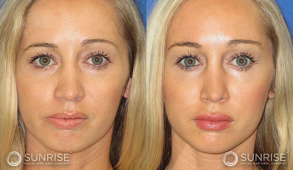 Brow Lift Before & After