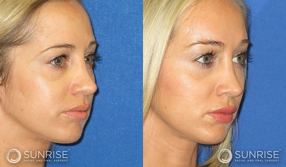 Brow Lift Before & After